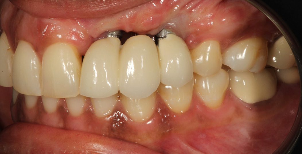 The image shows a close-up view of a person s mouth with severely decayed teeth, some missing, and one tooth prominently featuring a large cavity.