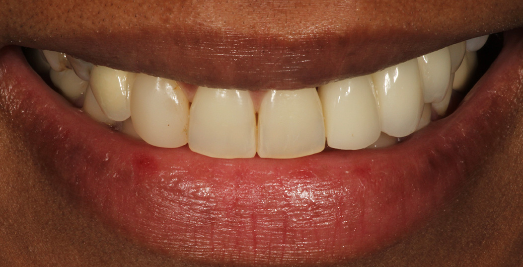 The image shows a close-up of a smiling person with white teeth, displaying a wide smile.