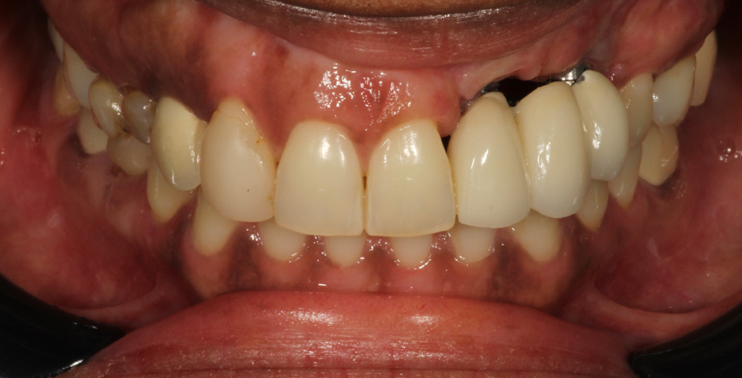 The image shows a close-up of a person s mouth with teeth exhibiting signs of decay and gum inflammation, suggesting poor oral hygiene or dental health issues.