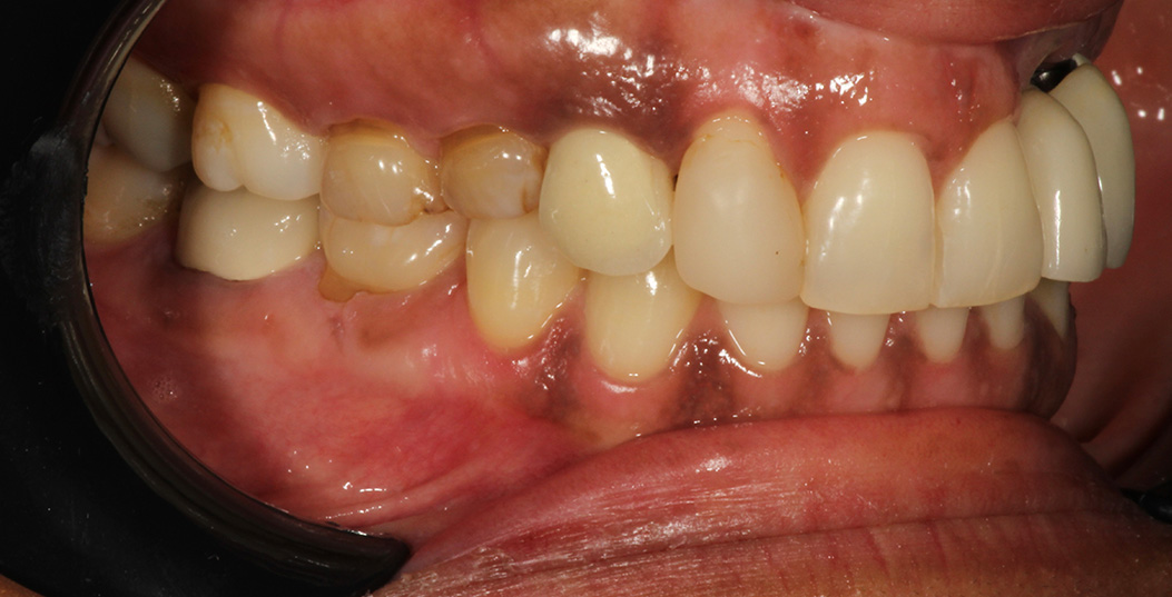 The image shows a close-up of an individual s mouth with visible teeth discoloration and decay, featuring brown stains and yellowing, indicating poor oral hygiene or health issues.