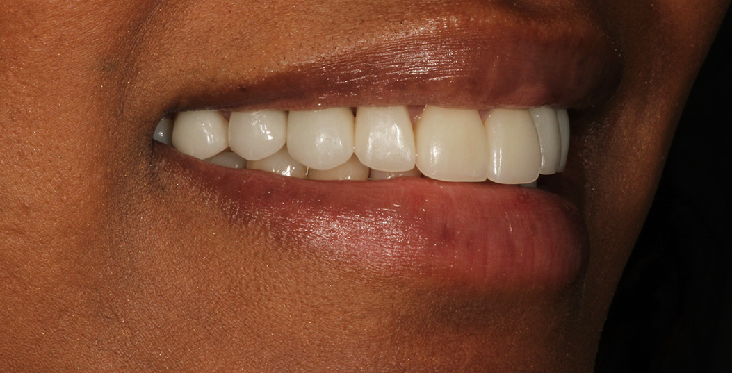 The image shows a close-up of a person s mouth with teeth, smiling, with a focus on their teeth and lips.
