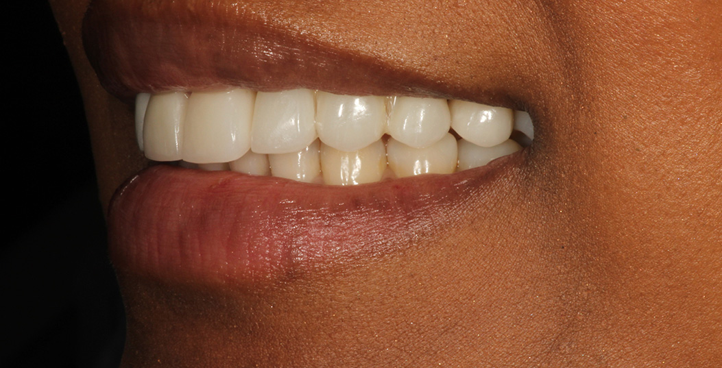 The image shows a close-up of a person s smile, with teeth clearly visible against a darker background.