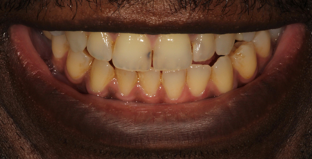 The image displays a close-up of a person s teeth with an open mouth, showing yellowed teeth and gums, set against a neutral background.