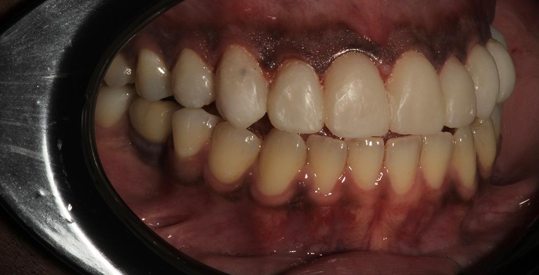 The image shows a close-up of a person s mouth with teeth that are discolored and possibly decaying, set against a blurred background which appears to be a metallic object with reflective surfaces.