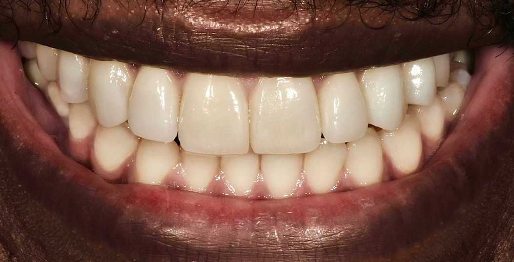 The image shows a person with a wide smile revealing teeth, set against a dark background.