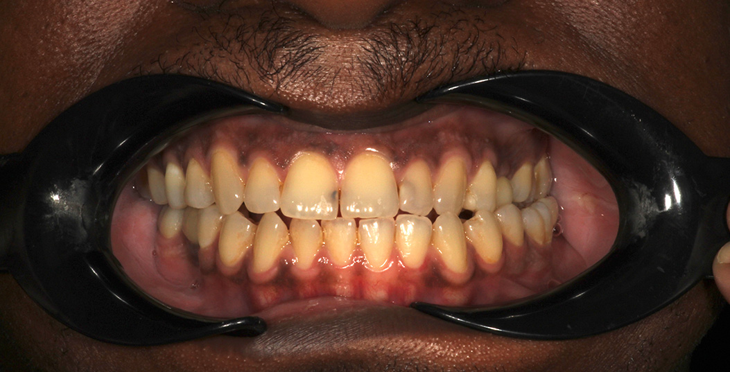 The image shows a person wearing a dental mouth guard with an open mouth displaying multiple yellowed teeth, which suggests poor oral hygiene or dental health issues.