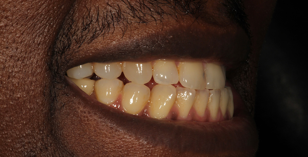 The image shows a close-up view of a person s mouth with teeth showing, and there is visible yellowing on the teeth.