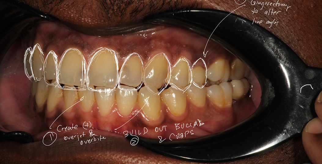 An extreme close-up of an open mouth showing a dental implant being fitted with a surgical tool visible in the foreground.