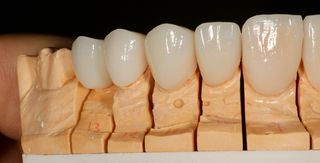 The image shows a set of dentures with multiple teeth placed on a mold, possibly for adjustment or demonstration purposes.