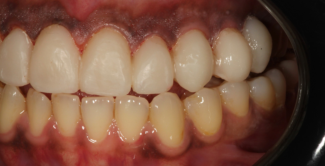 The image shows a close-up of a person s mouth with severely decayed teeth, some missing, and discoloration.