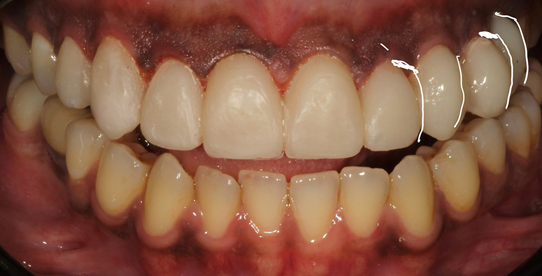 The image shows a close-up view of a person s mouth with a large set of teeth, some of which appear to be missing or damaged, against a background that includes a partial view of a hand holding a toothbrush.