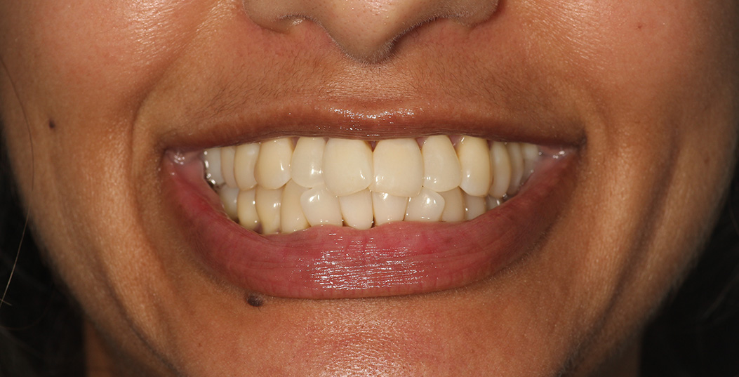 The image shows a person smiling with a noticeable gap between their teeth.