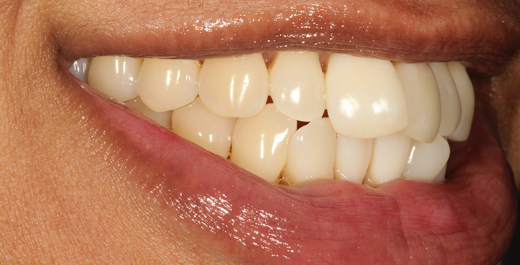 The image shows a close-up view of a person s smile with visible teeth and lips.
