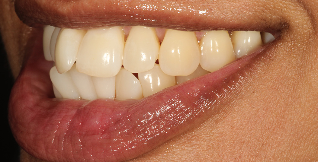 The image shows a close-up of a person s mouth with a wide smile displaying straight white teeth, and their lips are slightly parted revealing a small amount of tongue.