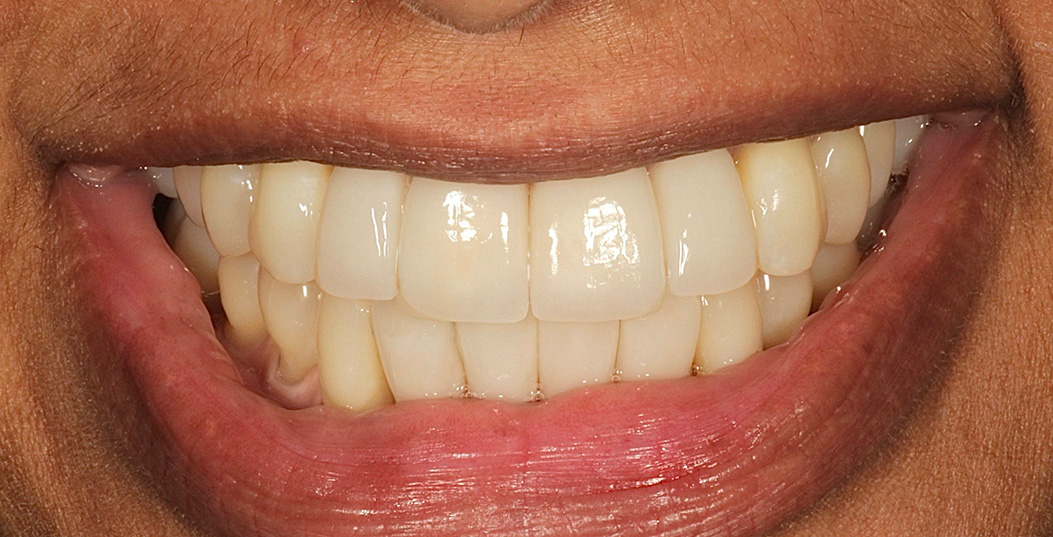 The image shows a person smiling with their teeth visible, displaying a wide grin and showing a bright smile.