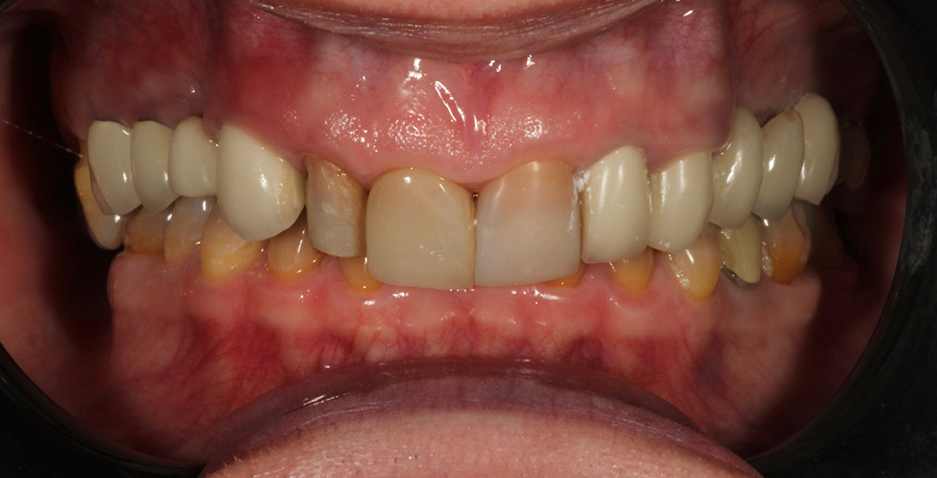 The image shows a close-up view of a person s mouth with yellowing teeth and visible signs of decay, possibly indicating poor oral hygiene or dental issues.