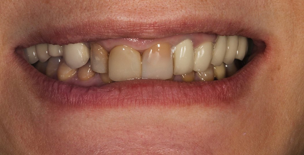 This image shows a person s close-up smiling face with teeth showing signs of discoloration and decay, particularly noticeable on the bottom front teeth.