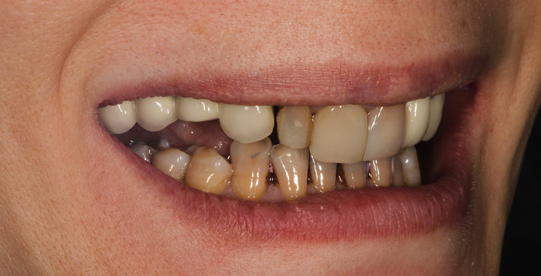 The image shows a person with a wide smile displaying their teeth, which appear yellowed and possibly stained.