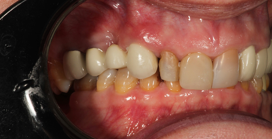 The image shows a close-up view of a person s mouth with yellow teeth and a pinkish gumline, which could indicate poor oral hygiene or an ongoing dental issue.