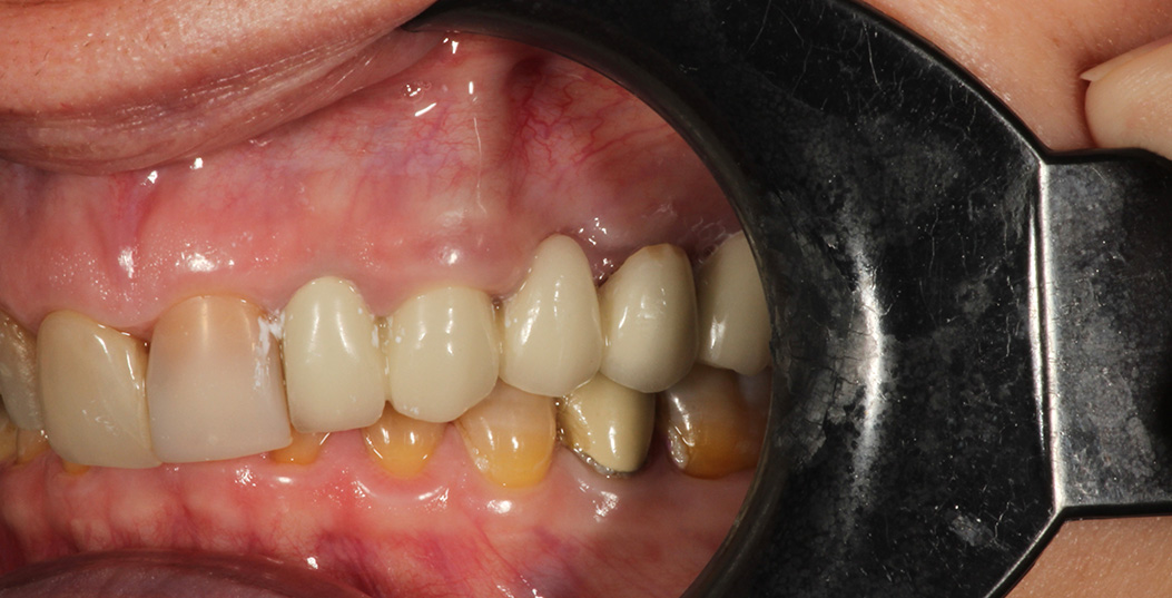 The image shows a person s open mouth with visible teeth and gums, and there is an instrument resembling a dental mirror held up to the mouth, likely for examination purposes.