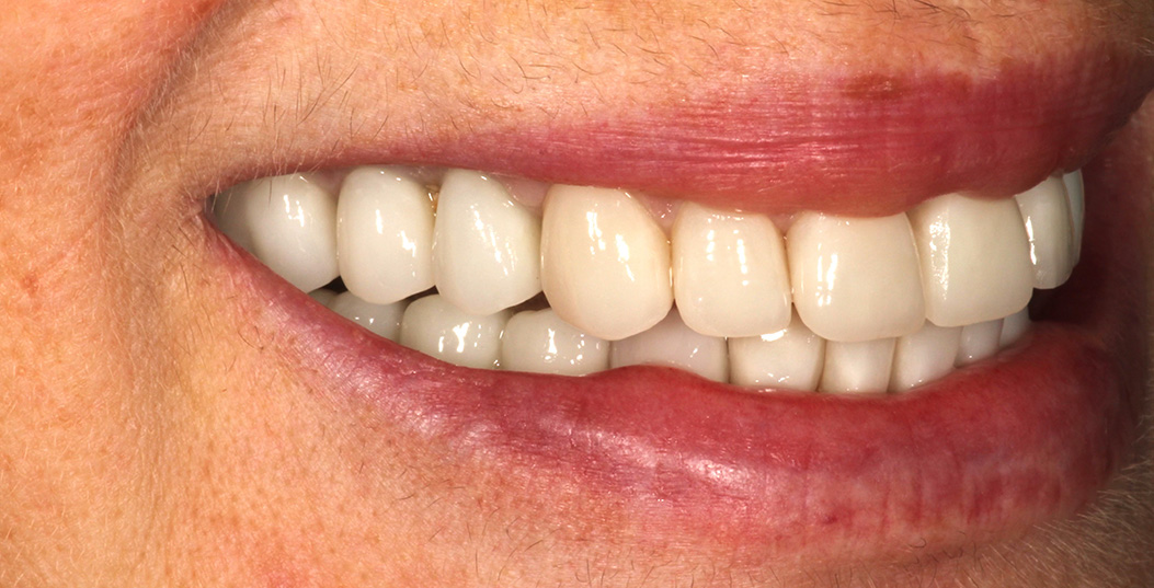 The image shows a close-up of a person s mouth with teeth, smiling broadly.