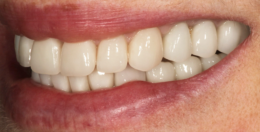 The image shows a close-up of a person s smile with white teeth, featuring a bright smile and an open mouth.