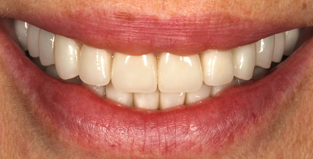 The image shows a person smiling broadly with white teeth and pink lips, revealing a wide smile that exposes their upper teeth and gums.