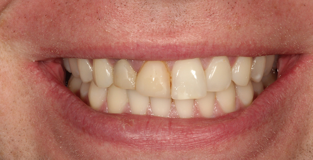 The image features a person smiling with their teeth, showcasing a dental implant on the left side of their mouth.