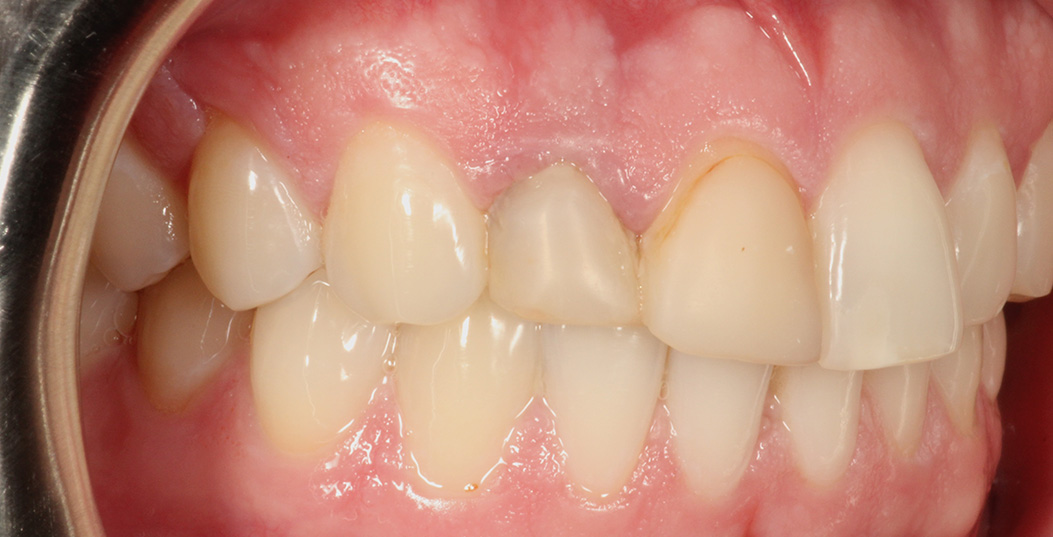 The image shows a close-up view of an open human mouth with visible teeth and gums, against a blurred background.
