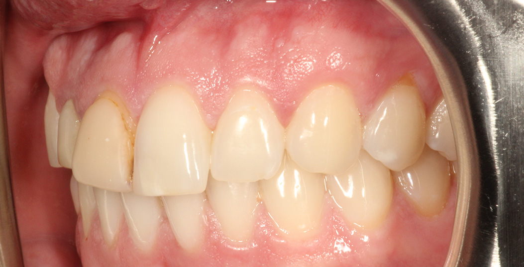 The image shows a close-up view of a person s teeth with an open mouth, revealing the inside of the mouth and dental work.