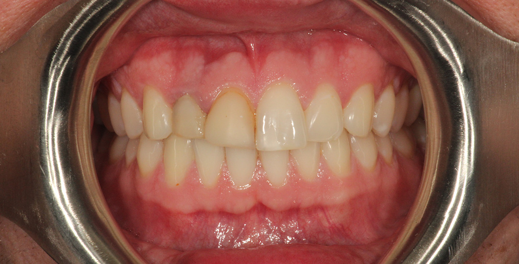 The image shows a close-up of a person s teeth with a red gumline, viewed through a metal ring, possibly a dental mirror or tool.