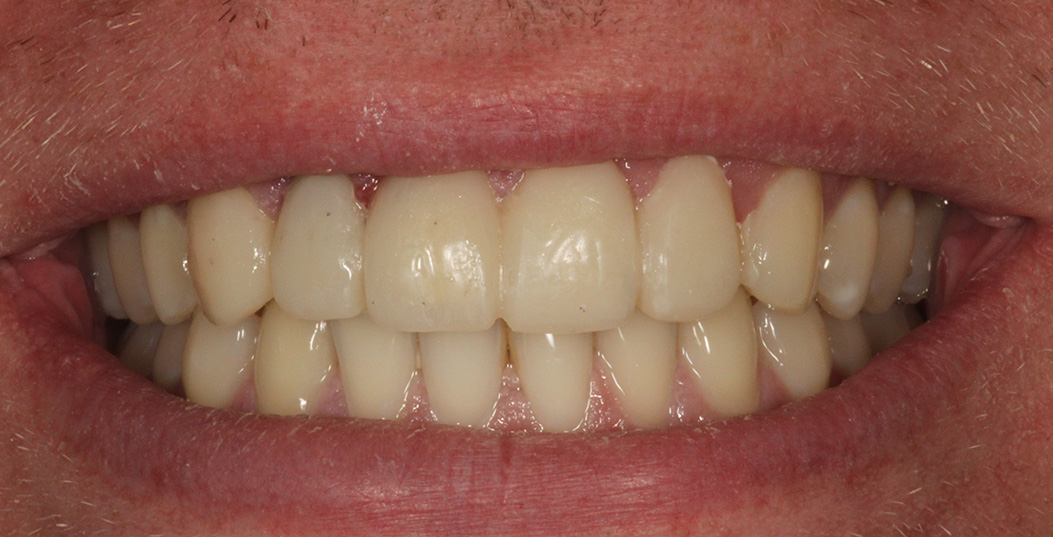 The image shows a person s mouth with yellowed teeth.