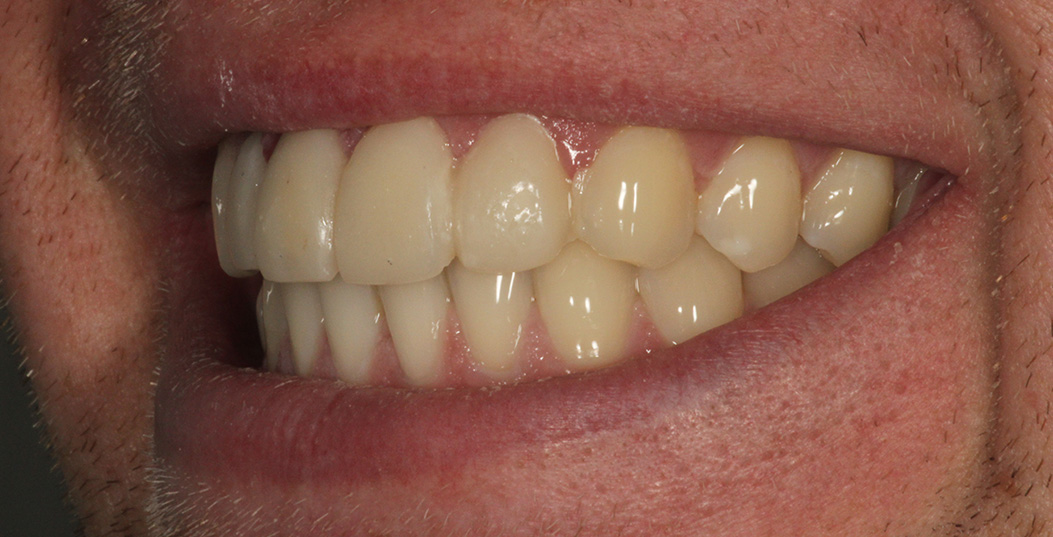 The image shows a close-up of a person s teeth with a smile, revealing yellowed teeth and a red gum line.