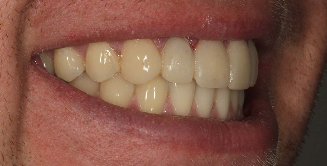 The image displays a close-up of a person s mouth with a wide smile revealing yellowed teeth, set against a neutral background.