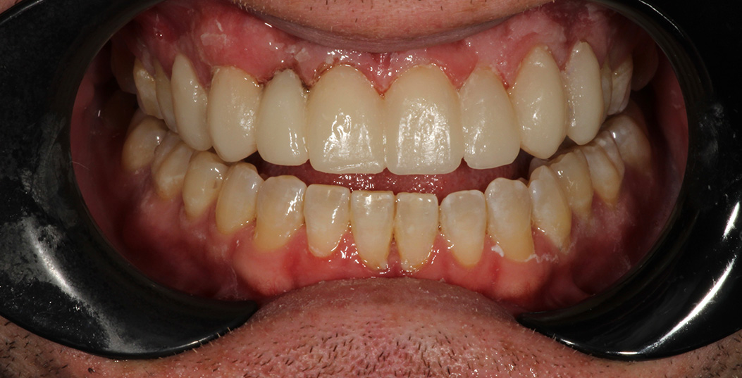 The image shows a close-up of a person s mouth with teeth, gums, and tongue visible, against a blurred background.