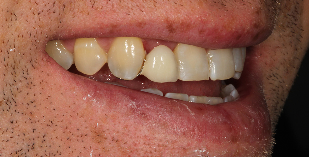 The image shows a close-up of a person s face with an open mouth revealing teeth and gums, along with a visible mustache and beard.