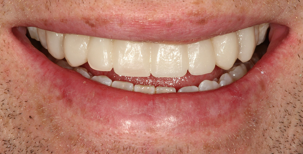 The image shows a smiling person with red lips, displaying a set of teeth, against a neutral background.
