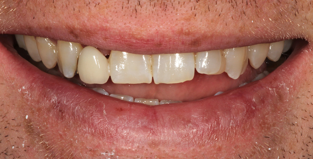 The image features a person with a broad smile showing teeth, displaying a large gap between front teeth and gums.