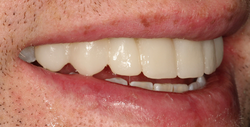 The image shows a close-up of a person s face with a wide smile, revealing teeth and a tongue piercing, set against an overlaid textured background that appears to be a grey gradient.