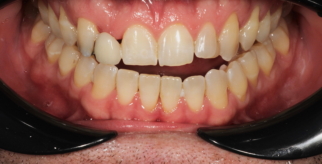 The image shows a close-up of a person s mouth with teeth that appear yellowed and stained, possibly due to tobacco use, with a gumline that looks pink and inflamed. There are also visible tartar buildup on the teeth and along the gumline.