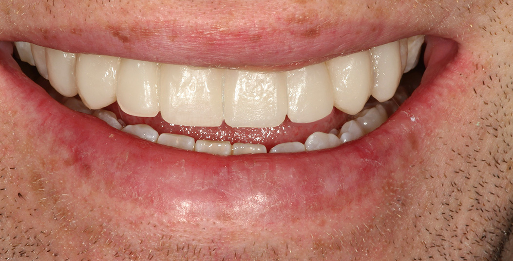 The image shows a close-up of an individual s smiling mouth with teeth showing, set against a blurred background.