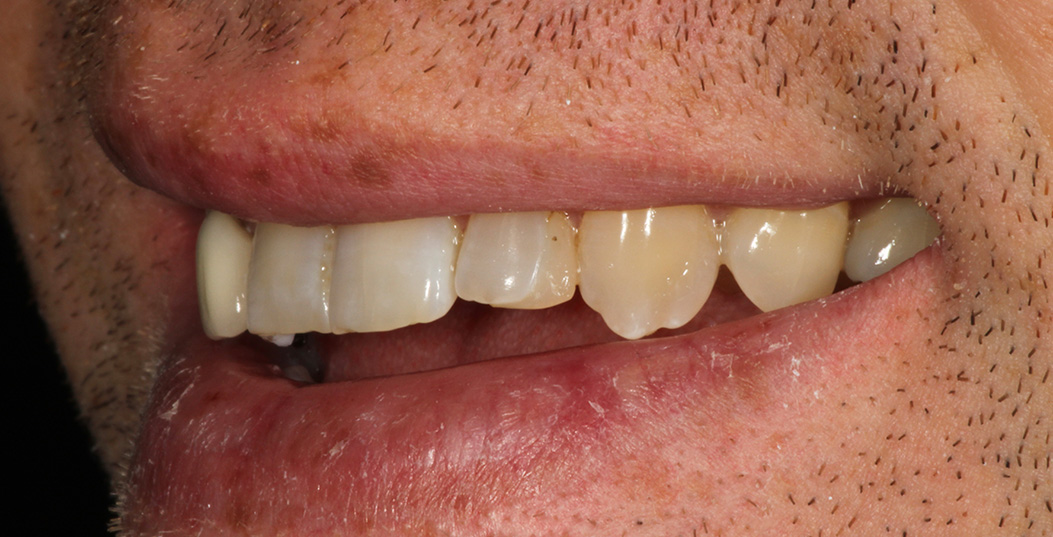 The image shows a close-up of a person s mouth with teeth showing, displaying signs of dental decay or damage.