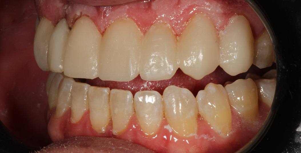 The image shows a close-up view of a person s mouth with teeth, some of which appear to be decayed or damaged, against a background that seems to be a medical setting, possibly a dental clinic.