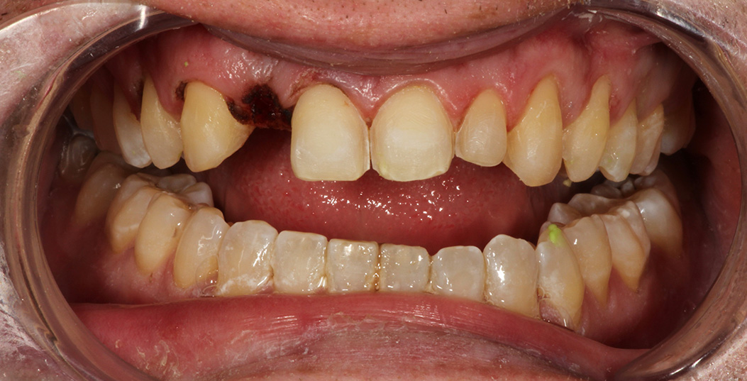 The image displays a close-up view of an individual s mouth with teeth showing, some of which are missing, and the person appears to be wearing glasses.