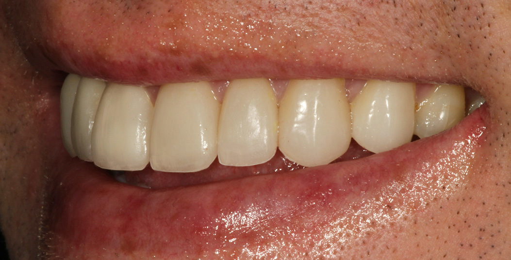 The image shows a close-up of a person s face with a wide smile revealing teeth, and there appears to be some redness or irritation on the lips.