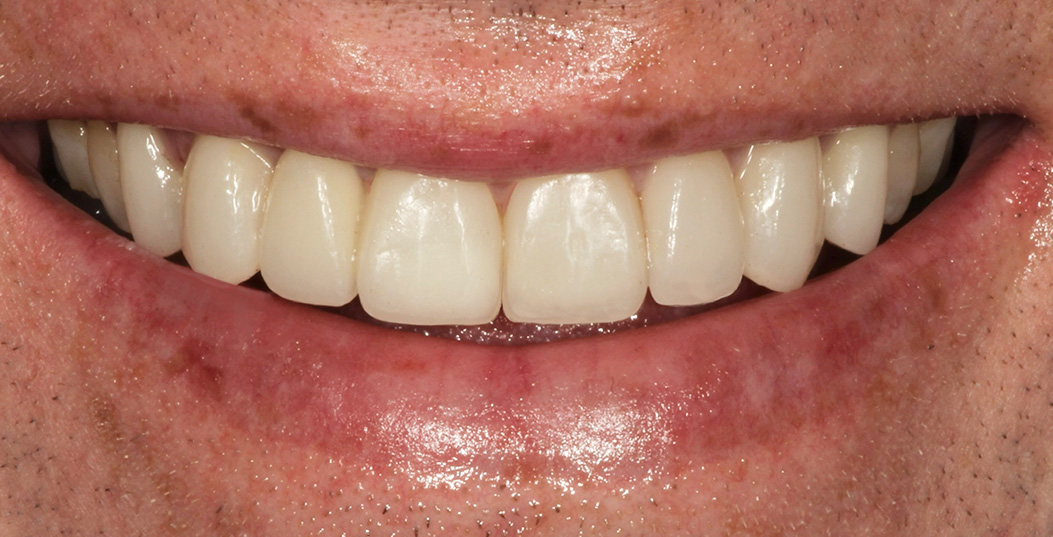 A man with a bright smile showing his teeth and gums, which appear healthy and clean.