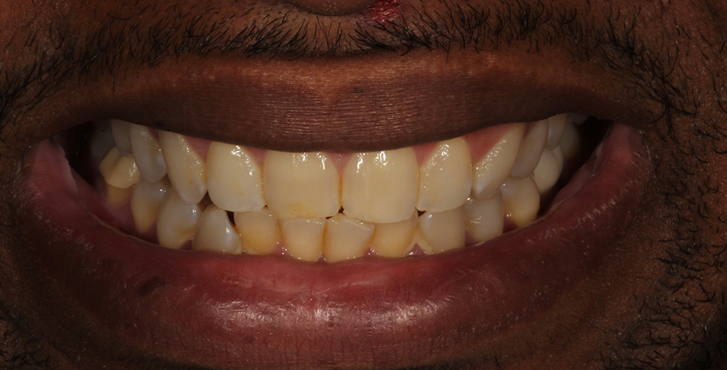 The image shows a close-up of a person with a wide smile displaying yellowed teeth, with a focus on their mouth and teeth.