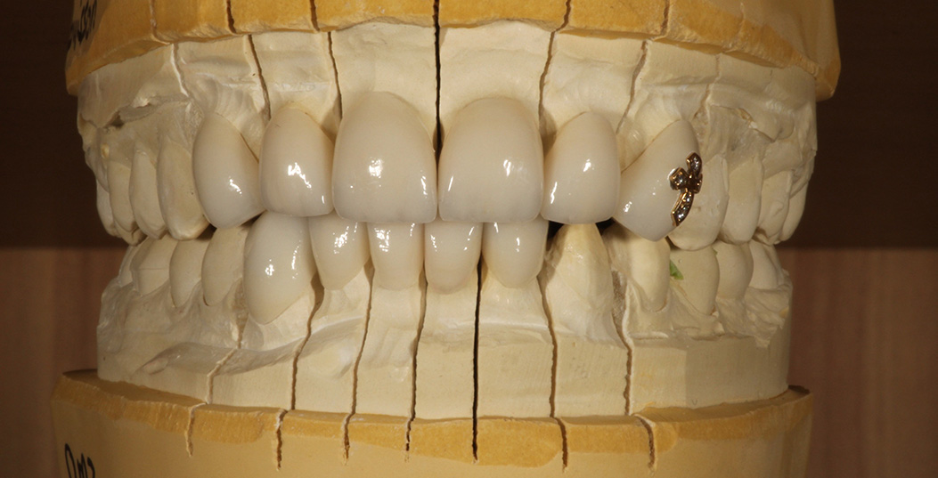 The image shows a close-up view of a human mouth with multiple teeth, some of which are yellowed, and one tooth appears to be missing or damaged at the front.