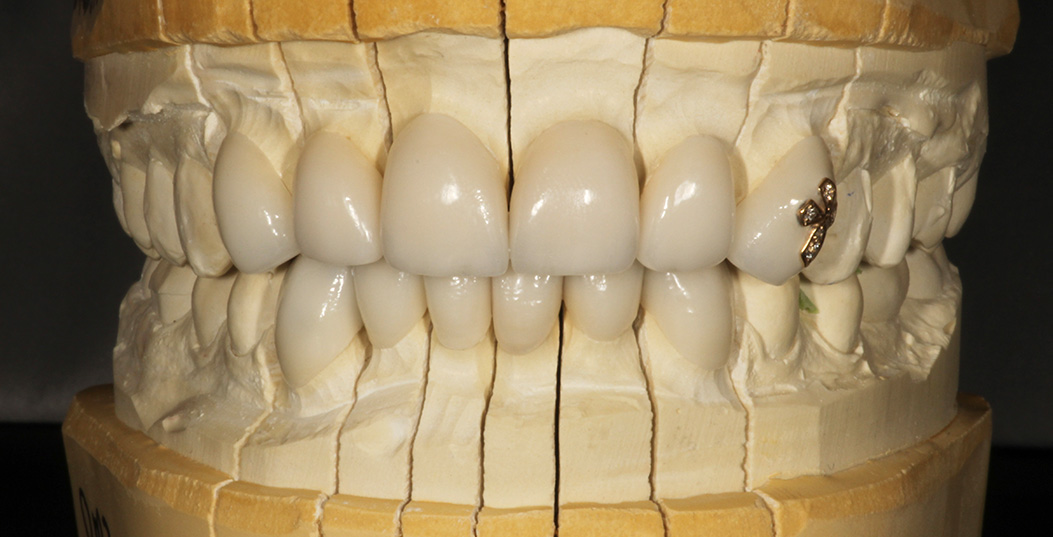 The image shows a close-up view of a human tooth with a visible cavity, displayed inside an open mouth model with a removable false tooth.