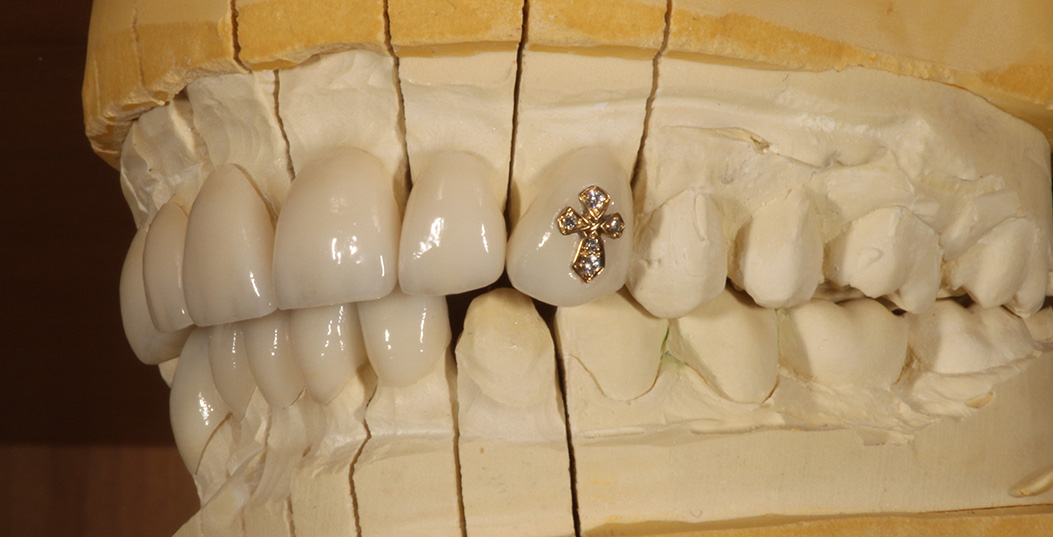 The image shows a close-up view of a set of human teeth with a diamond placed between them.